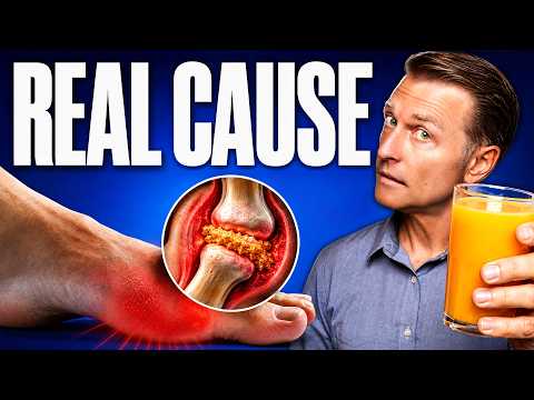 The #1 Best Protocol to Reverse Gout (& Prevent It)